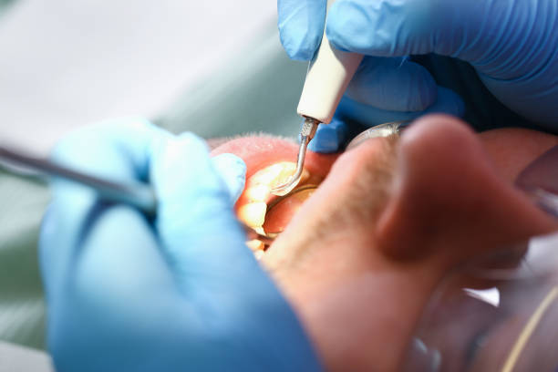 Best Teeth Whitening  in Ironde, AL